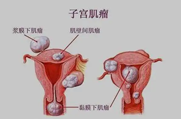 曲靖正规供卵机构：患有子宫肌瘤可以做试管婴儿吗？